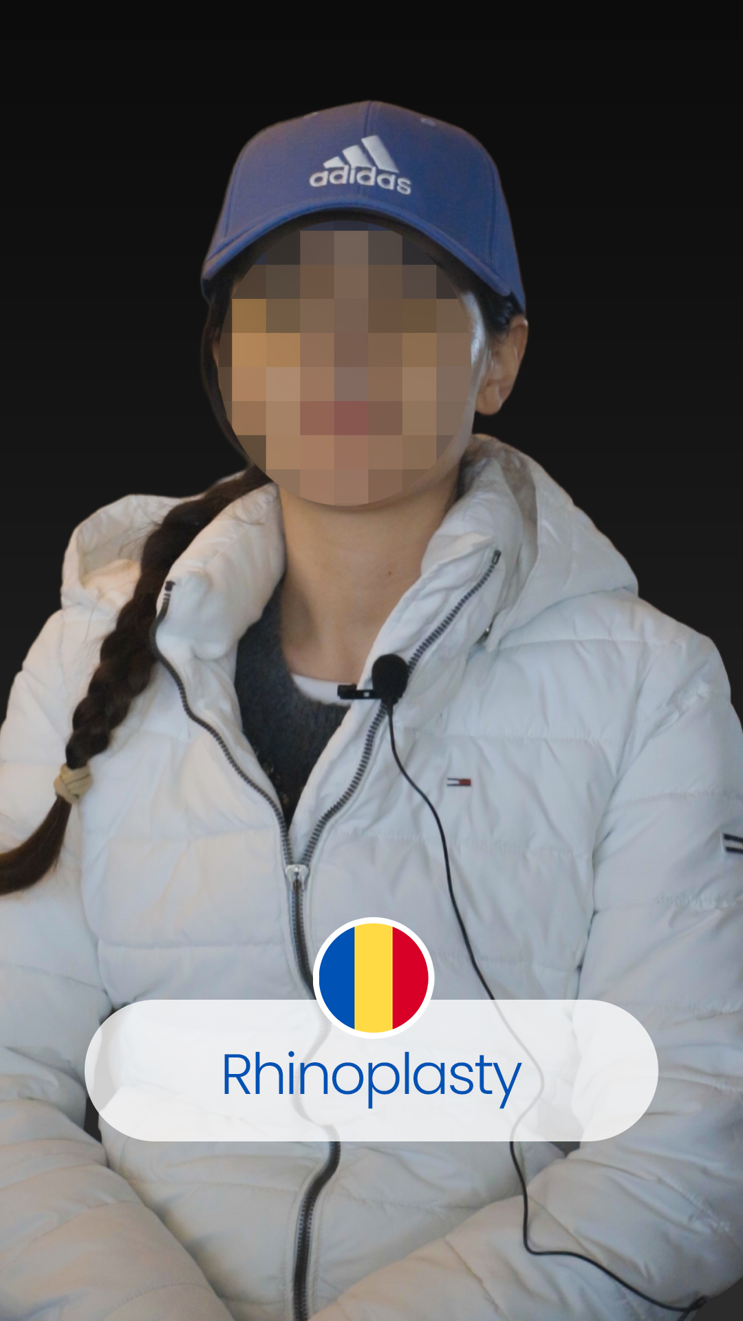 Patient Michael - Painless 4200 Grafts Hair Transplant at Avrupamed