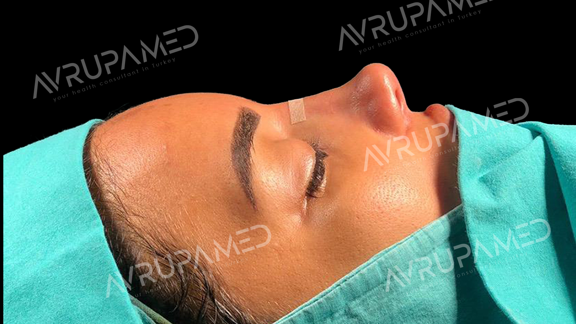 Rhinoplasty After Case 1