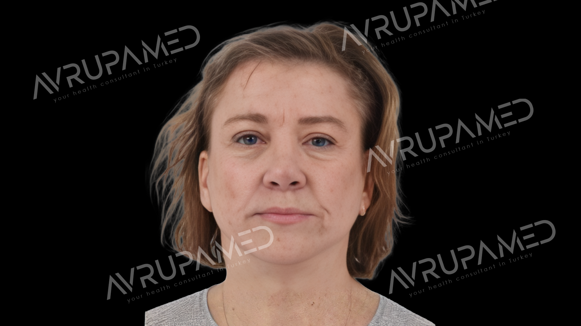 Facelift After Case 1