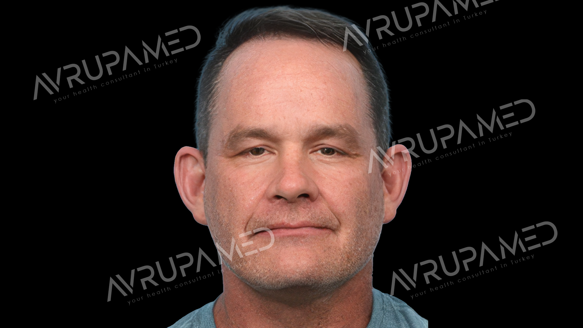Hair Transplant After Case 1