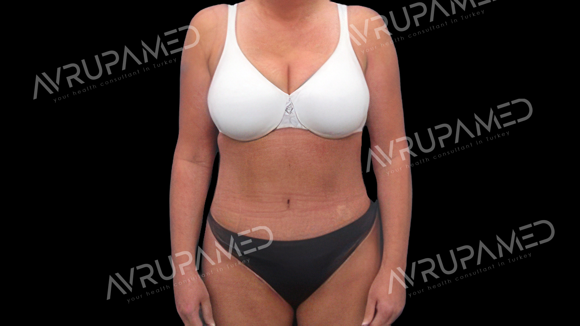 Tummy Tuck After Case 1
