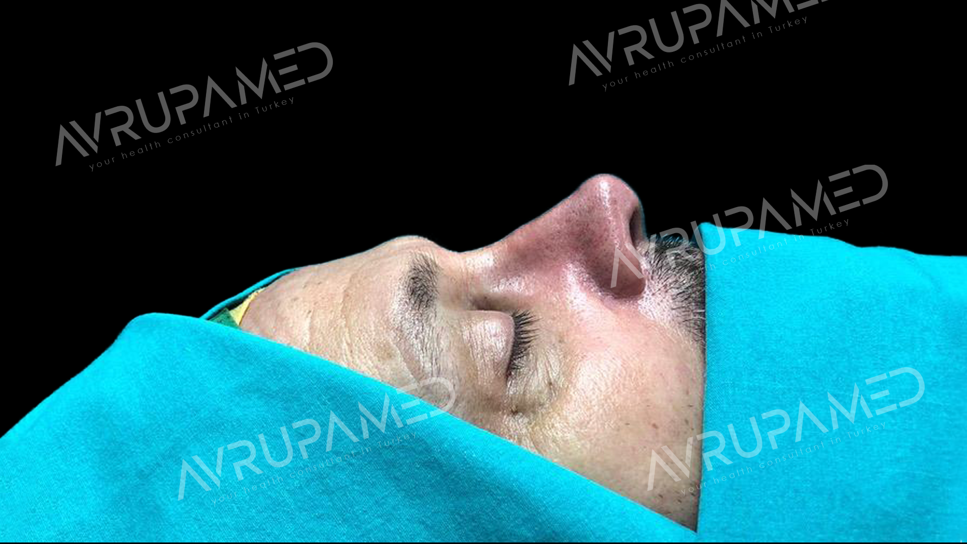 Rhinoplasty After Case 2