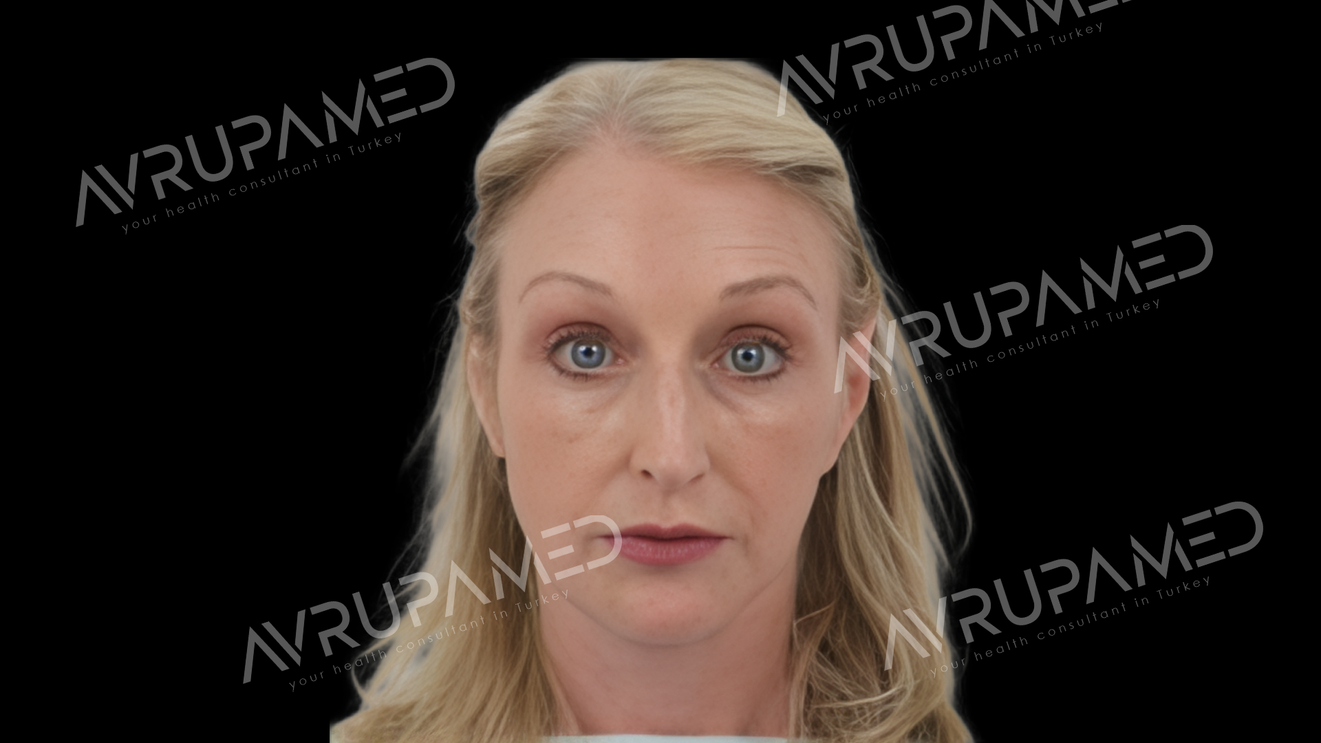 Facelift After Case 2