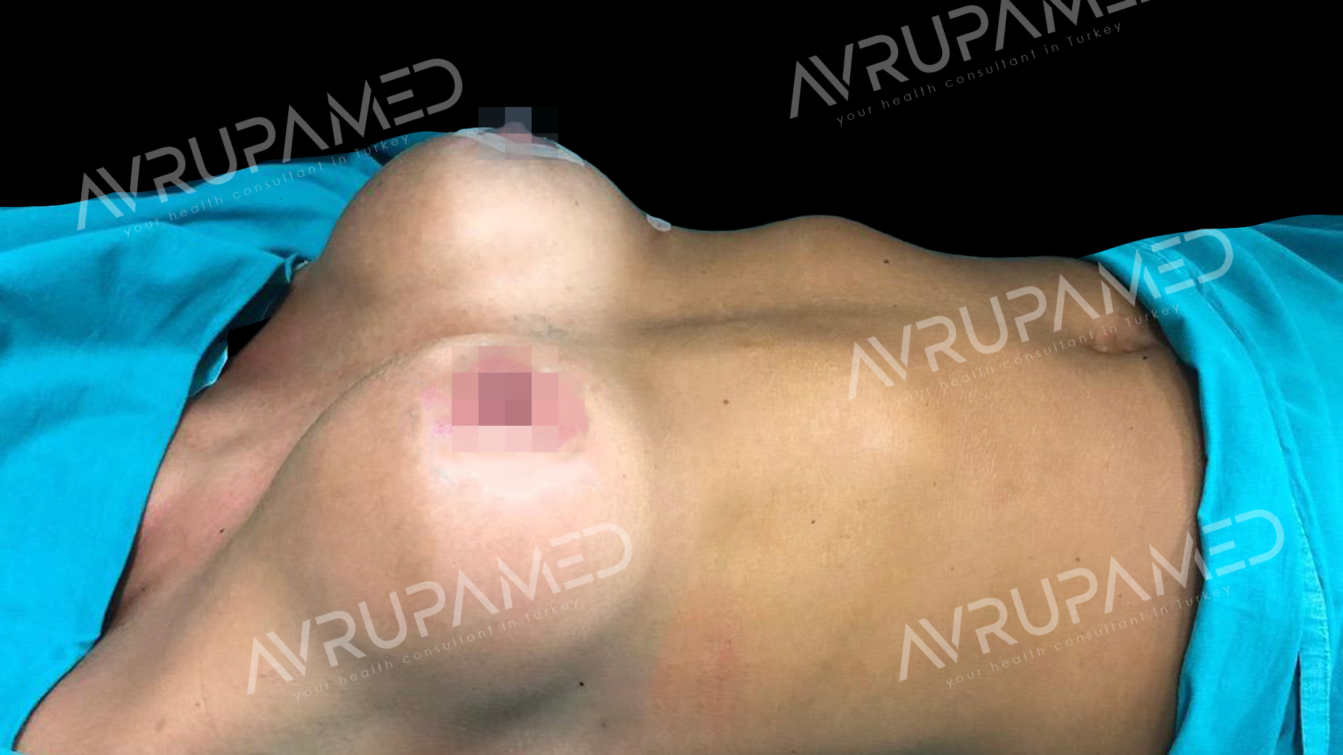 Breast Operation After Case 2