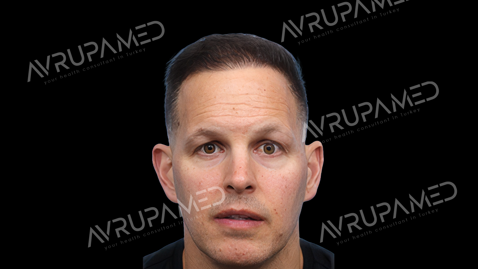 Hair Transplant After Case 2