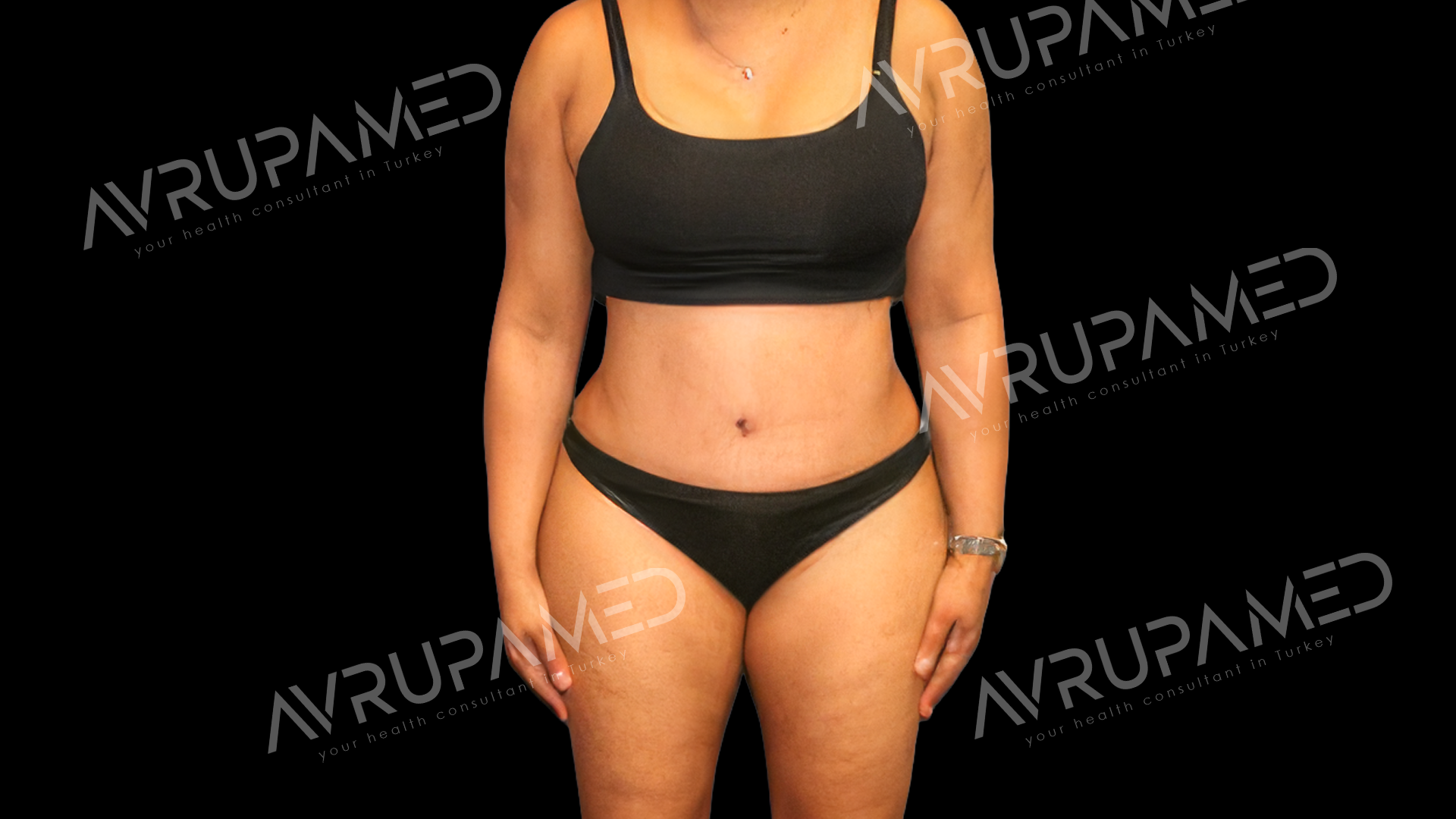Tummy Tuck After Case 2