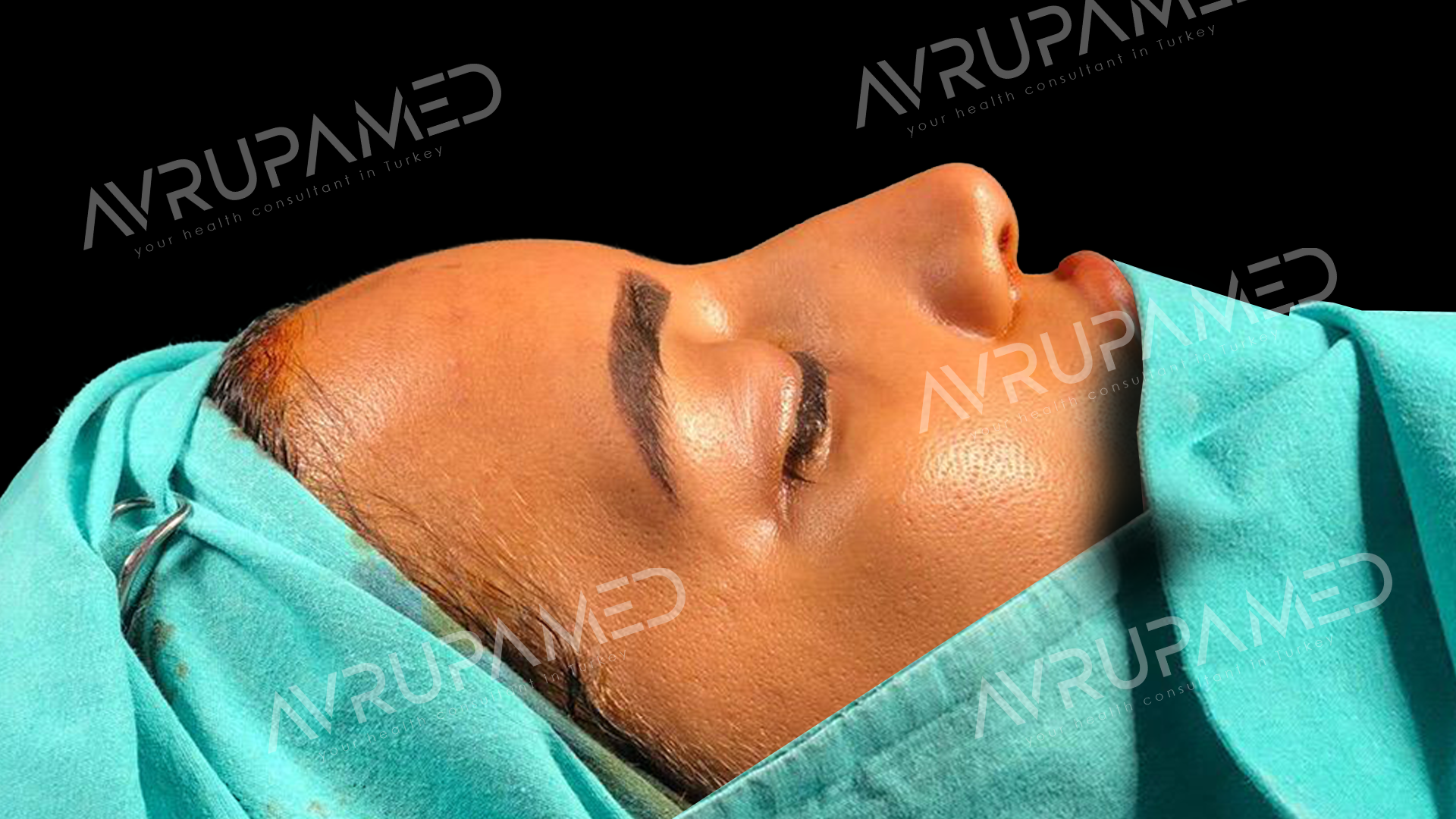 Rhinoplasty Before Case 1
