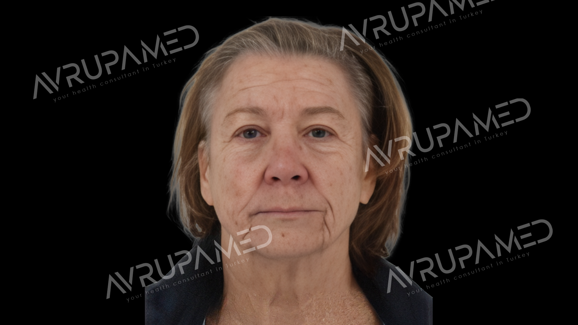 Facelift Before Case 1
