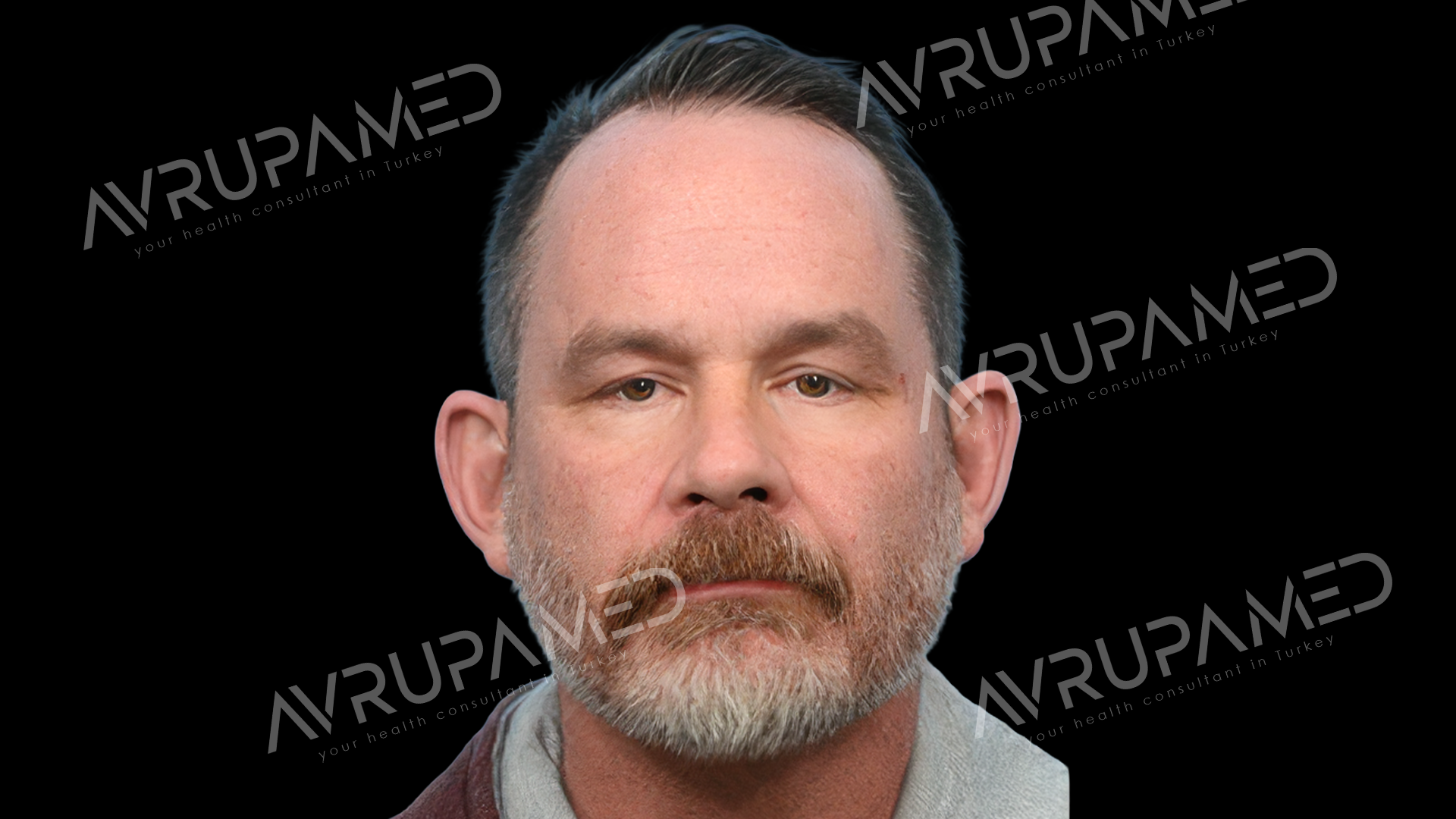 Hair Transplant Before Case 1