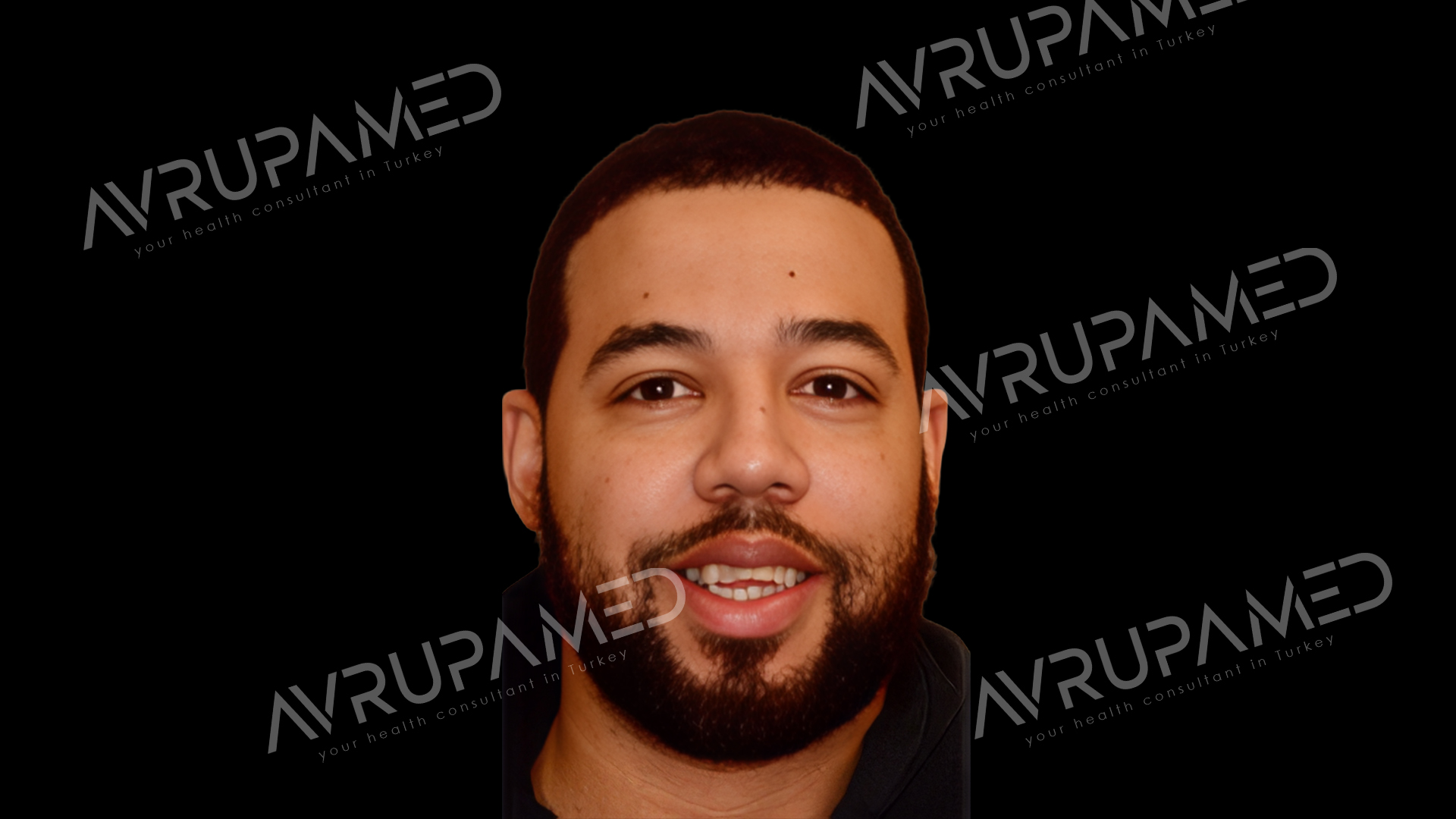 Hollywood Smile Before Case 1