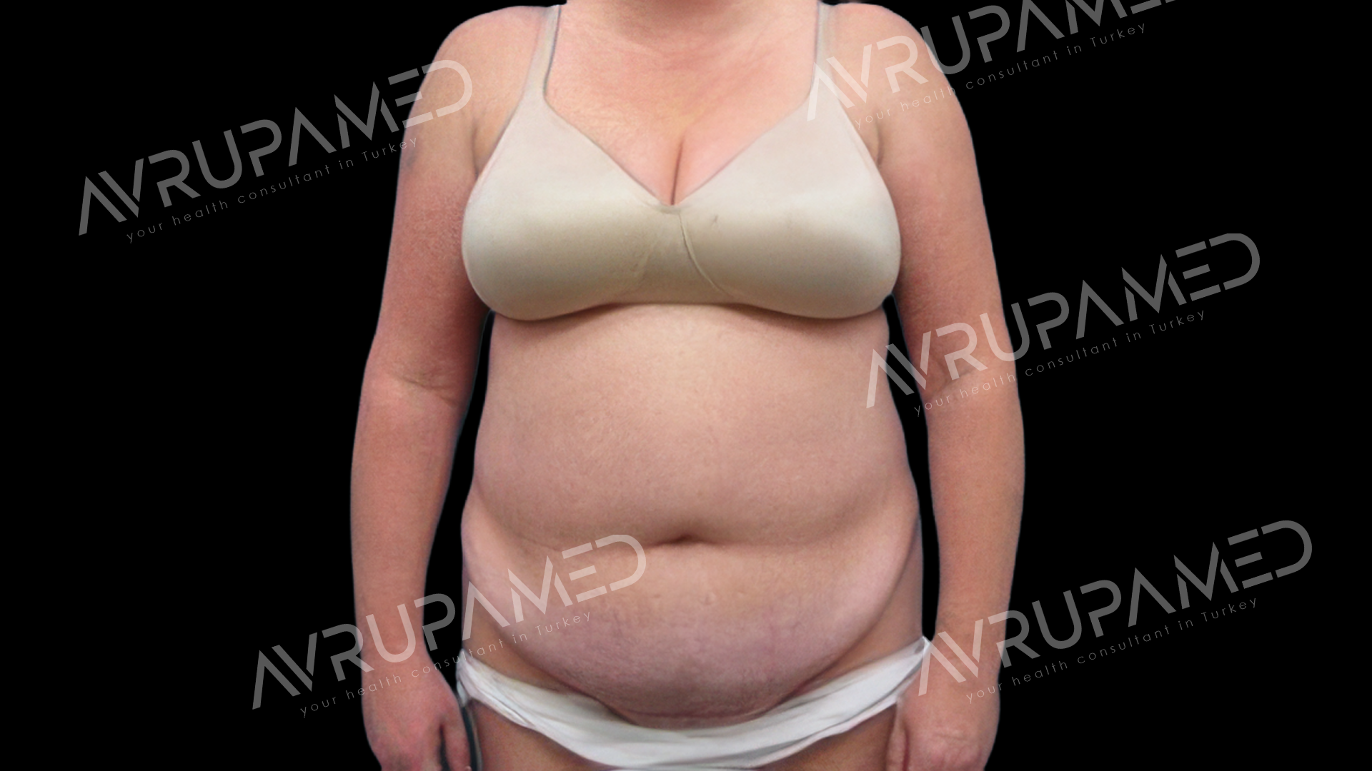 Tummy Tuck Before Case 1