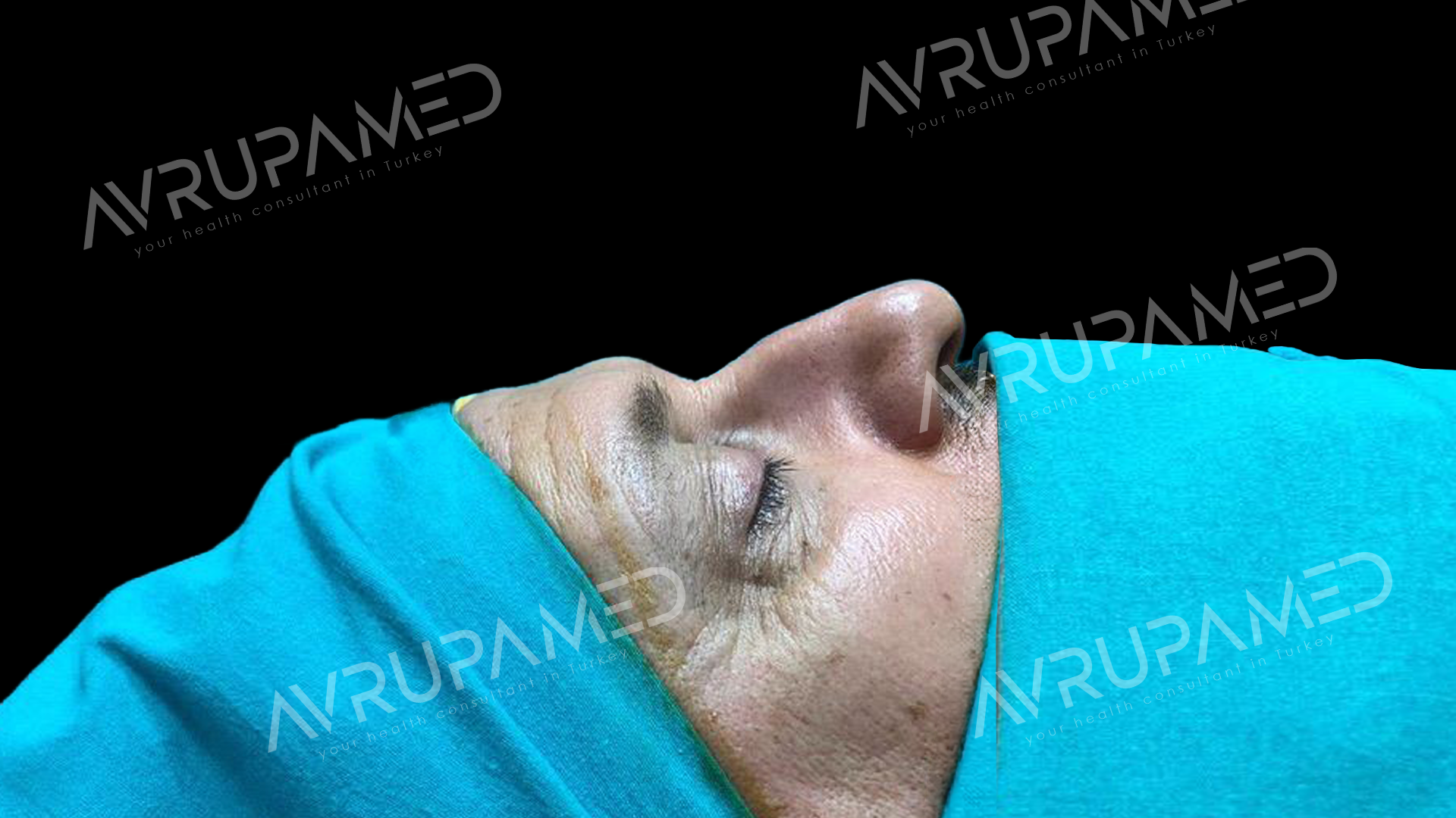 Rhinoplasty Before Case 2