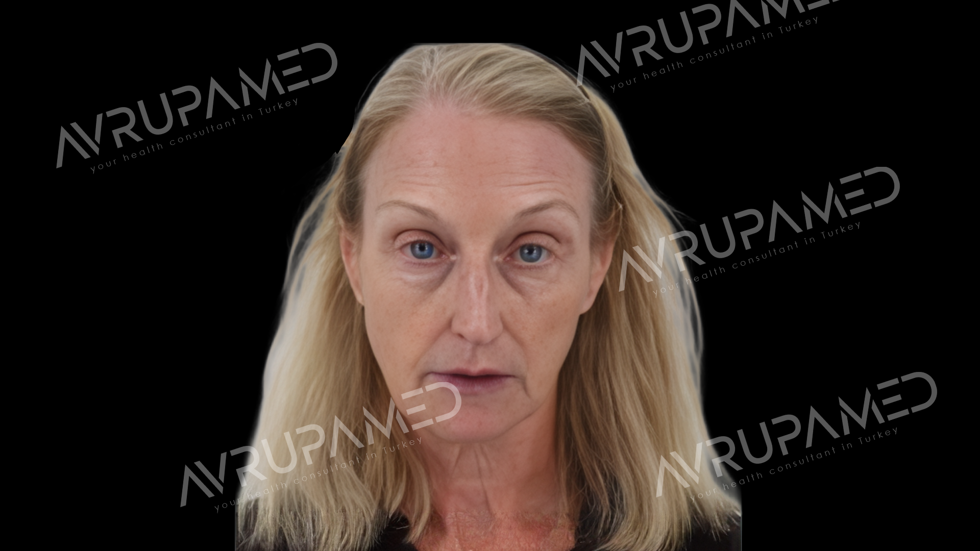 Facelift Before Case 2