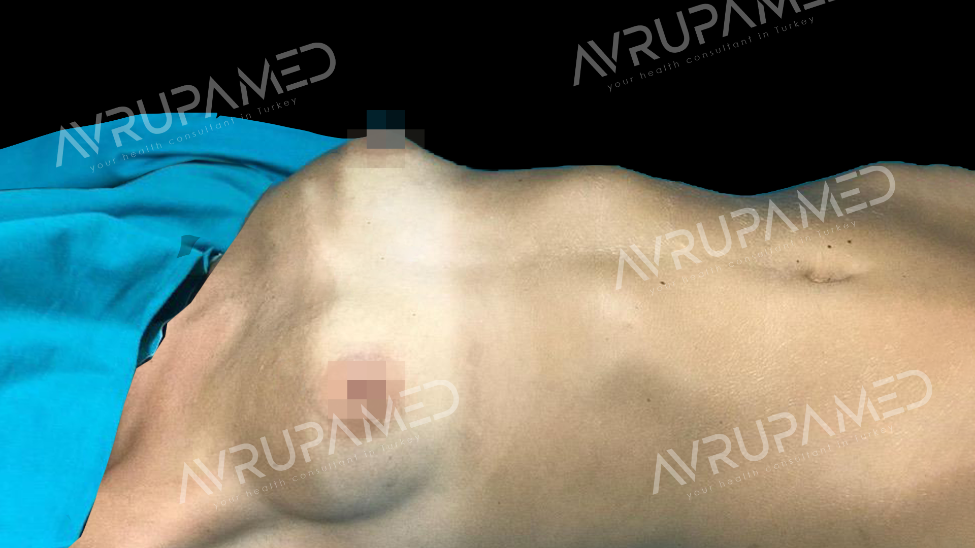 Breast Operation Before Case 2