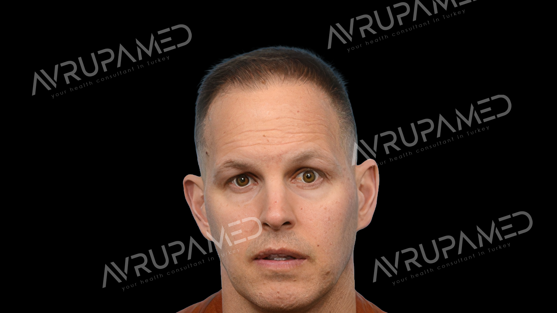 Hair Transplant Before Case 2