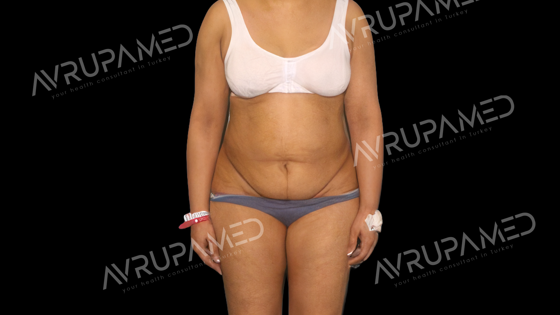 Tummy Tuck Before Case 2